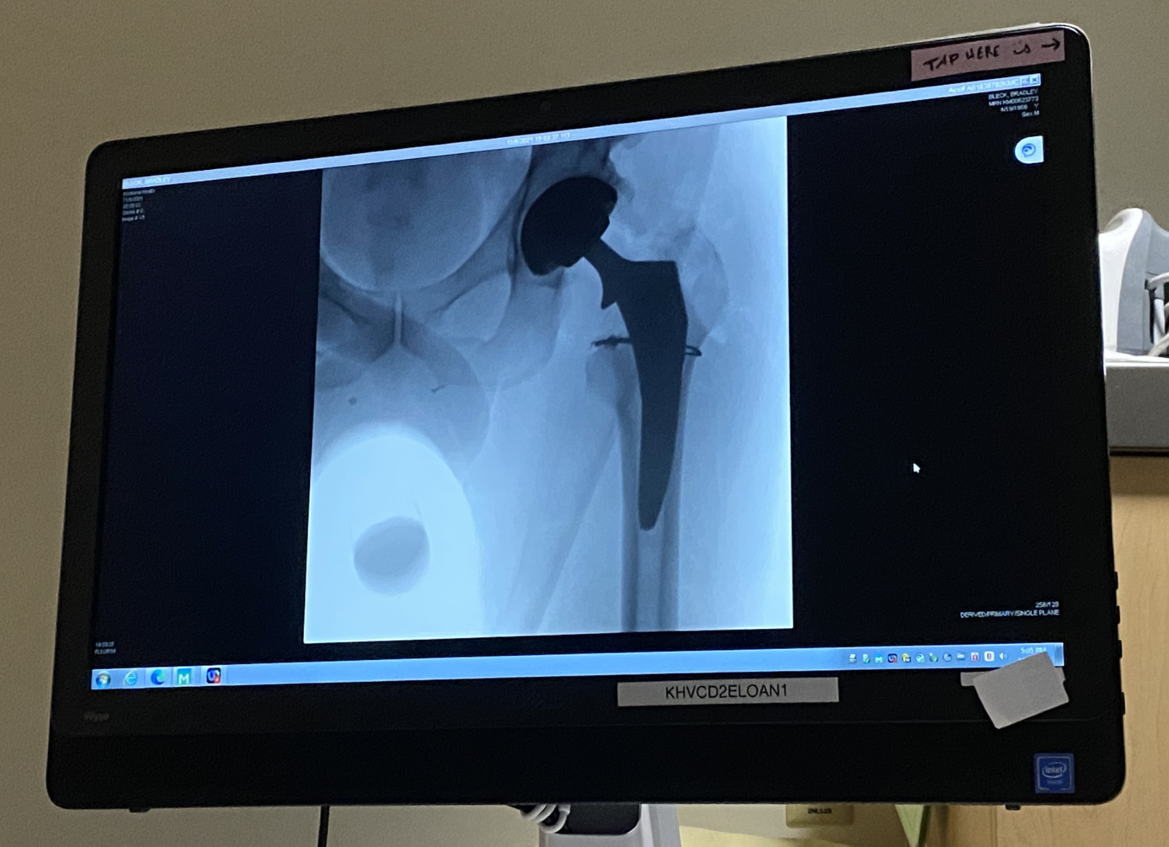 Recovering from hip replacement, X-ray of author's bionic hip - radiology image.
